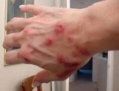 Papule sulla pelle con elmintiasi